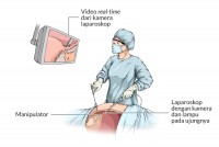 kelebihan-teknik-bedah-laparoskopi-0-alodokter.jpg