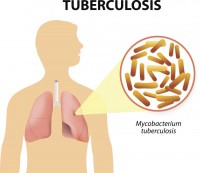 Tuberkulosis.jpg