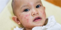 mengenal-gejala-alergi-obat-pada-anak-dan-perbedaannya-dengan-efek-samping-1564480479.jpg